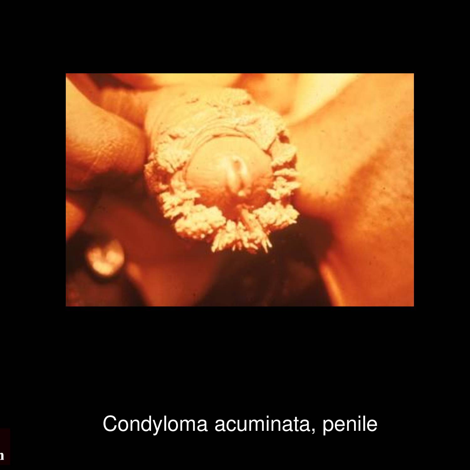 Condyloma acuminata genital warts on penile shaft showing characteristic cauliflower-like fleshy growths caused by HPV infection diagnosed at STD Nepal